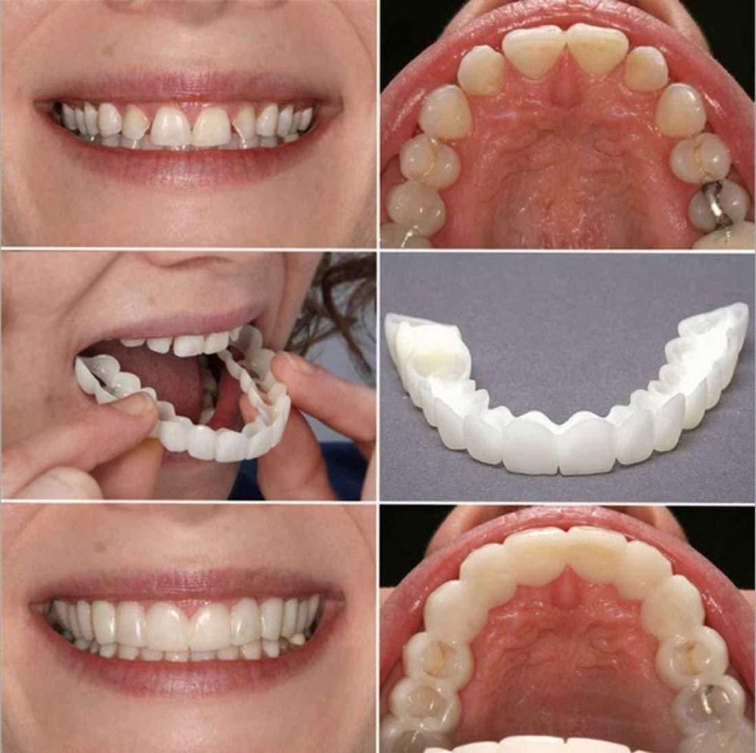 Teeth Veneer