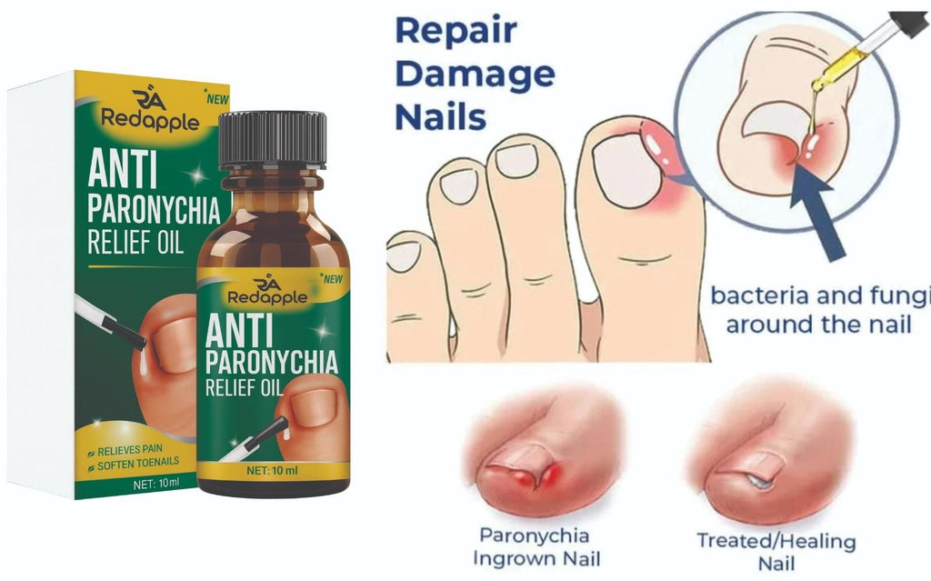 Paronychia Relief Oil